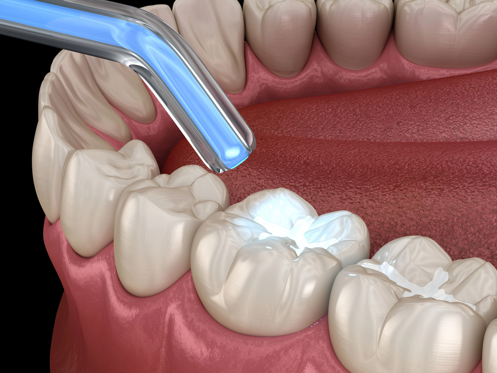 Composite Tooth Fillings