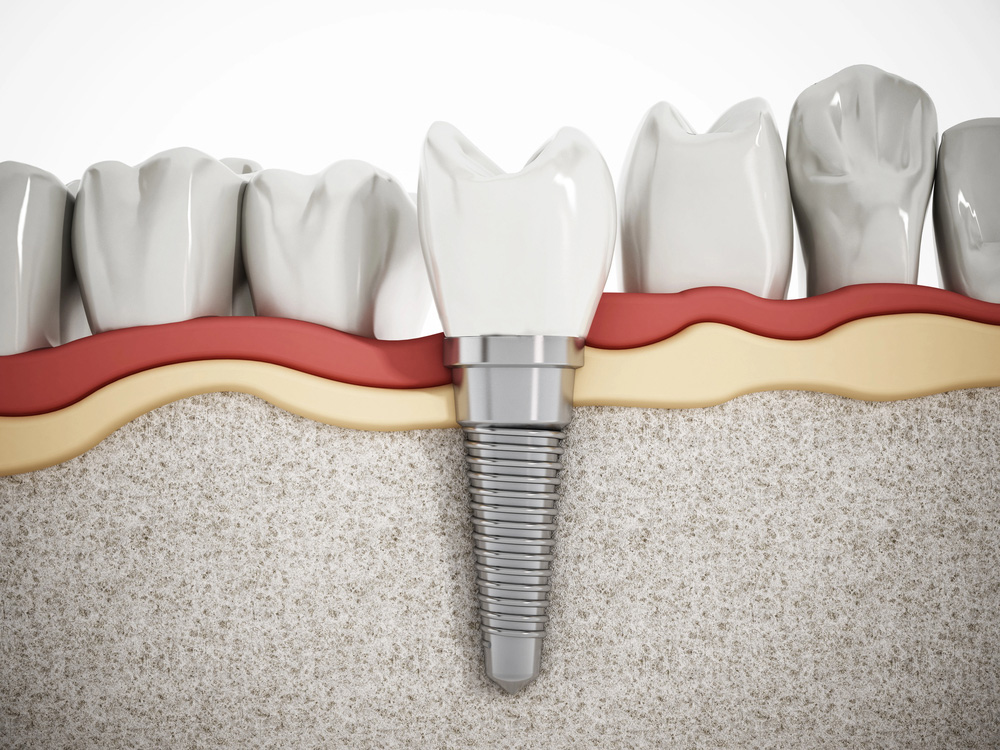 Replace Missing Teeth