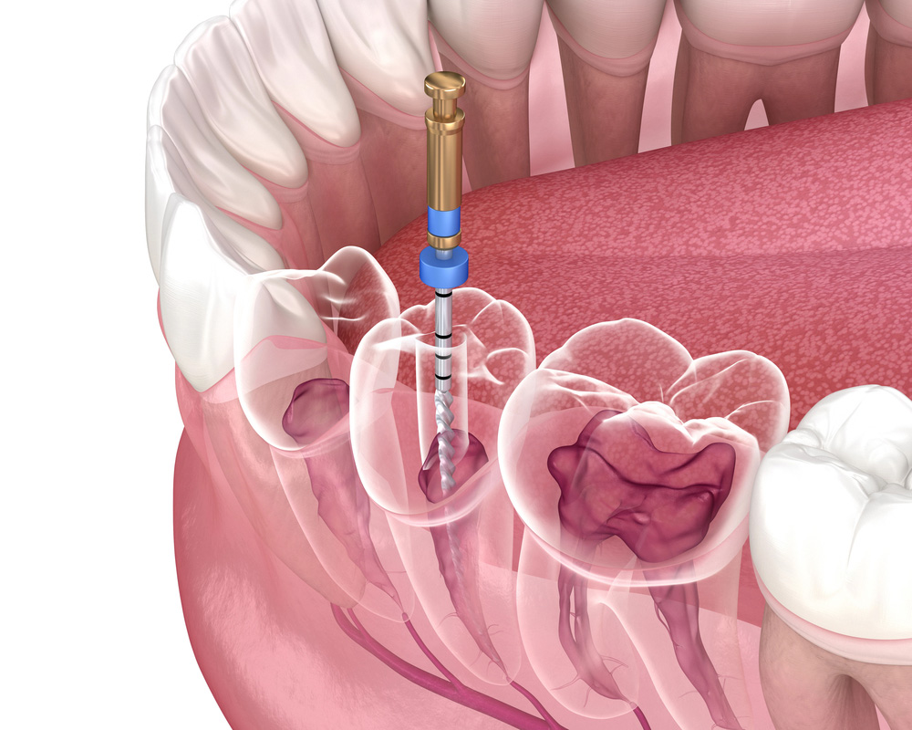 Root Canal Dentist